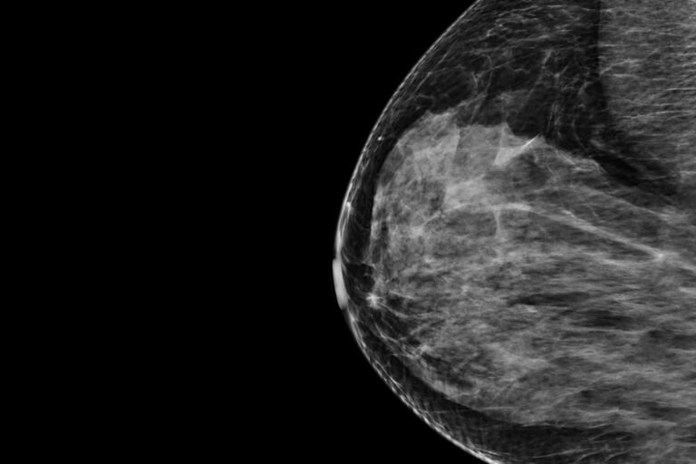 AI tool poised to rewrite breast cancer risk